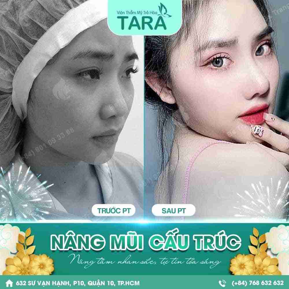 Nâng mũi cấu trúc bác sĩ Trang có vĩnh viễn không? 
