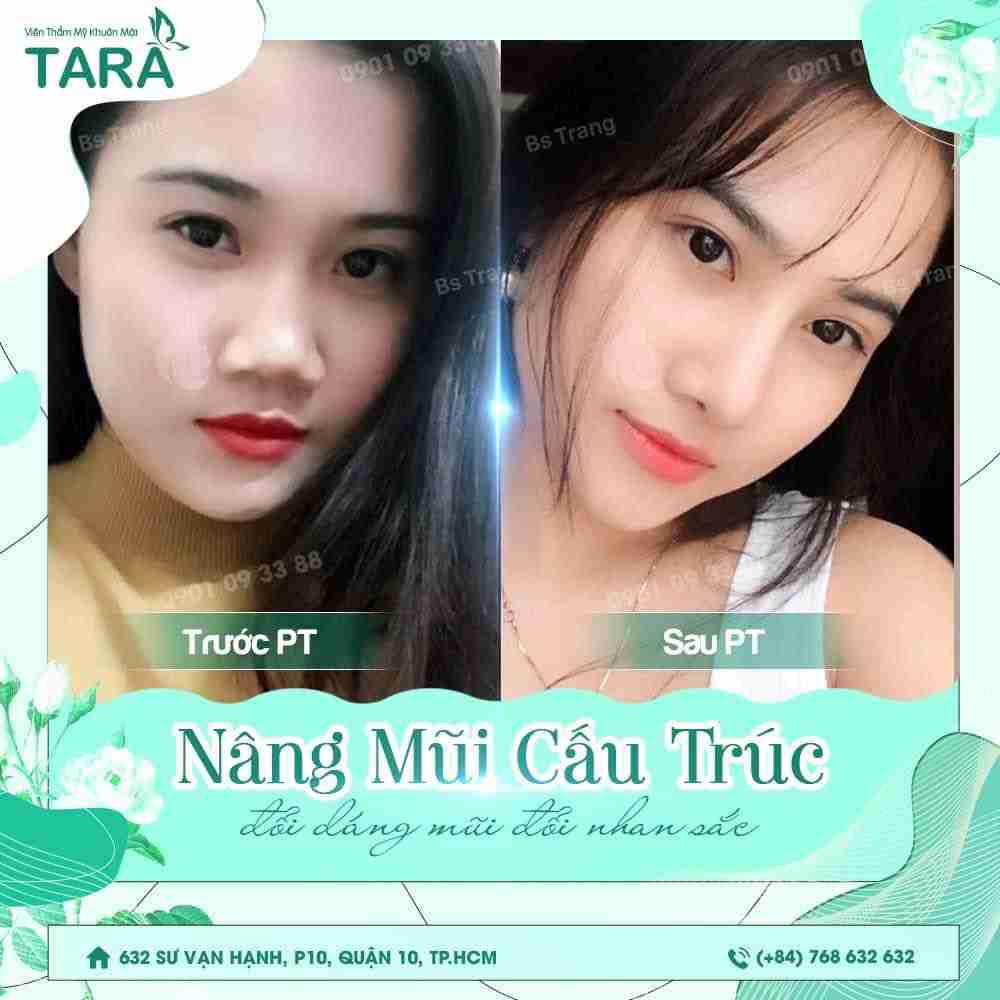 Nâng mũi cấu trúc bác sĩ Trang có vĩnh viễn không? 