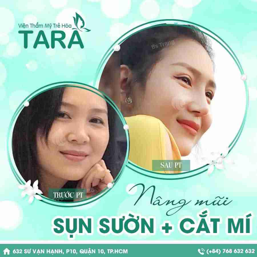 Nên cắt mí hay nhấn mí mắt thì tốt hơn? 