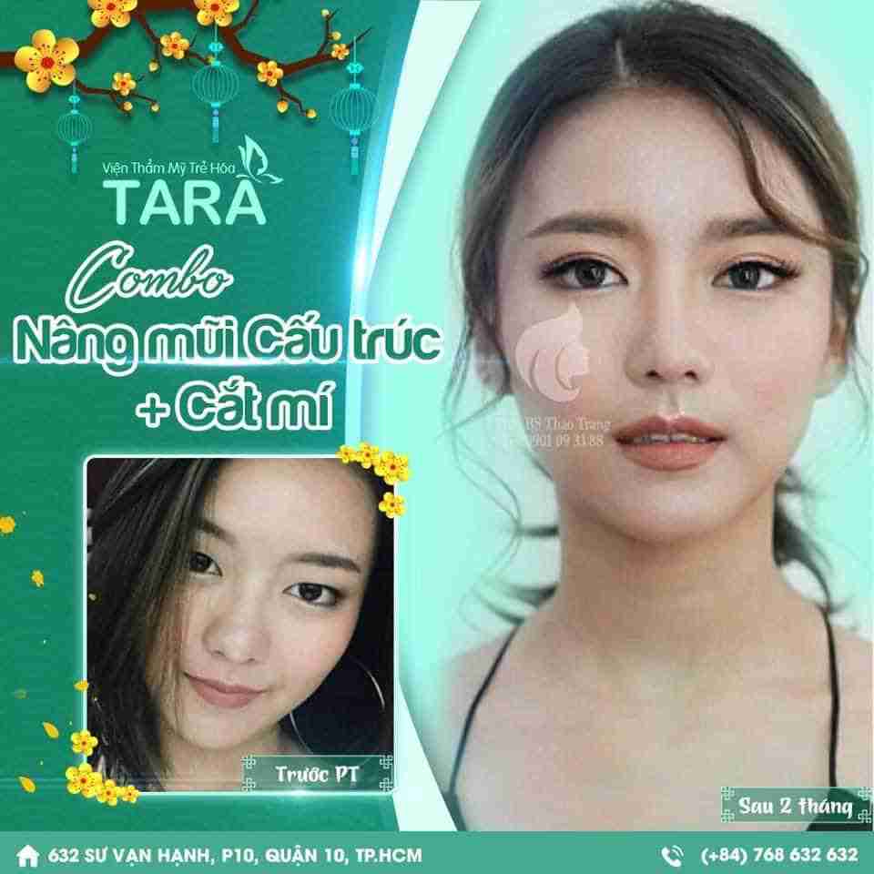 Nên cắt mí hay nhấn mí mắt thì tốt hơn 