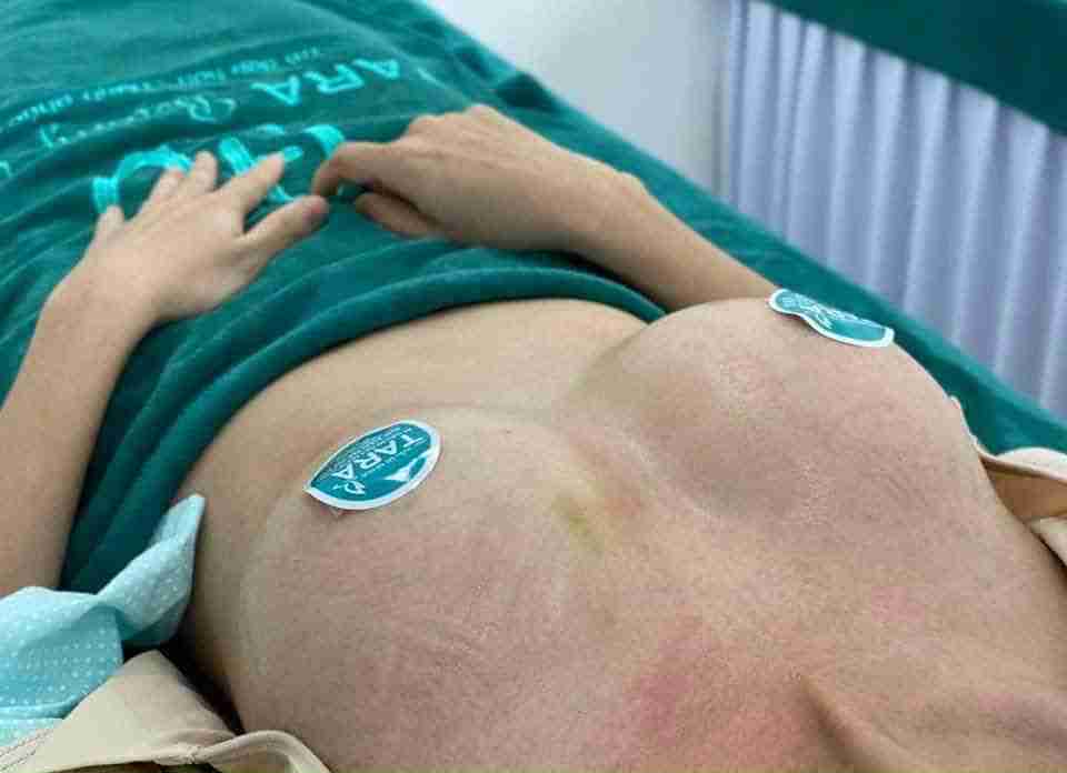 Những câu hỏi thường gặp khi phẫu thuật nâng ngực