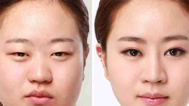 Quy trình 8 bước cắt mí bác sĩ Trang: Đẹp và An toàn