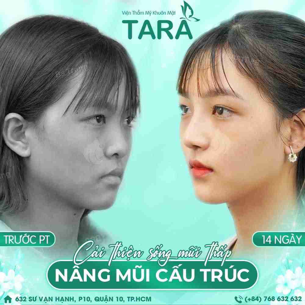 Da mũi mỏng nâng mũi có nguy hiểm không