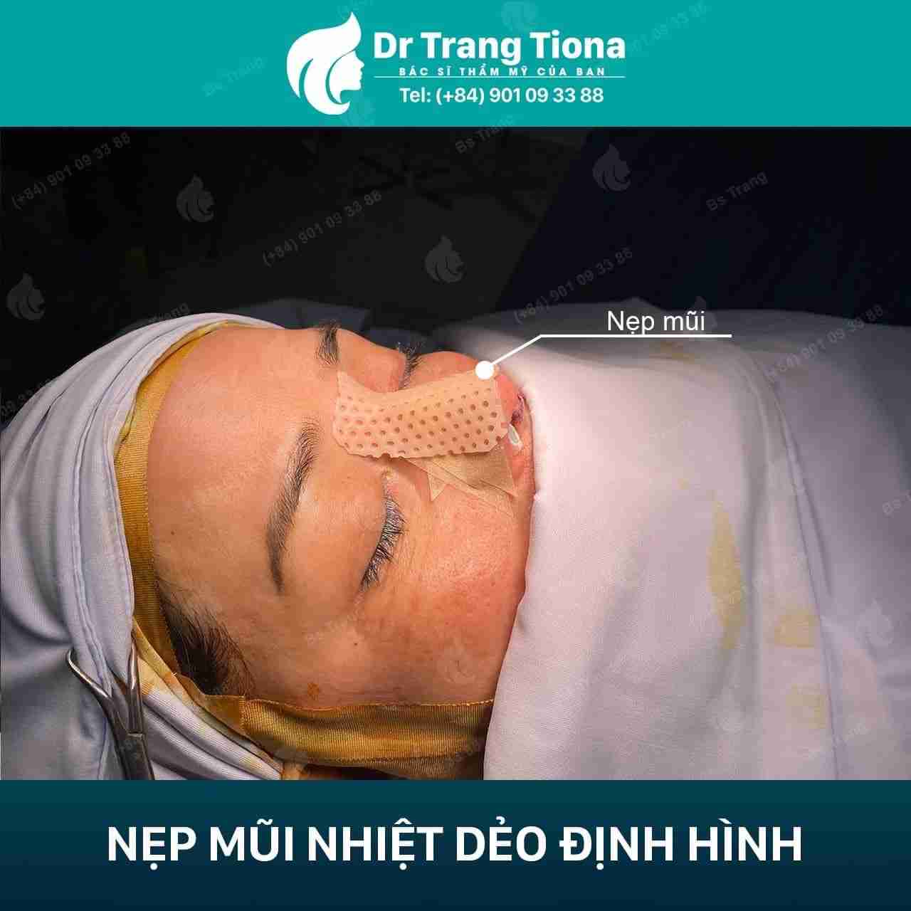 làm tan máu bầm sau nâng mũi hiệu quả
