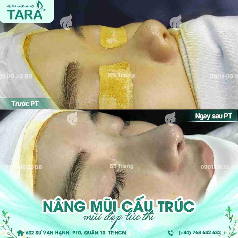 Nâng mũi ăn trứng có nguy hiểm không?
