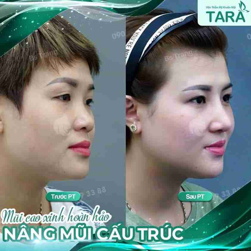 Lưu ý quan trọng khi nâng mũi sau 10 ngày