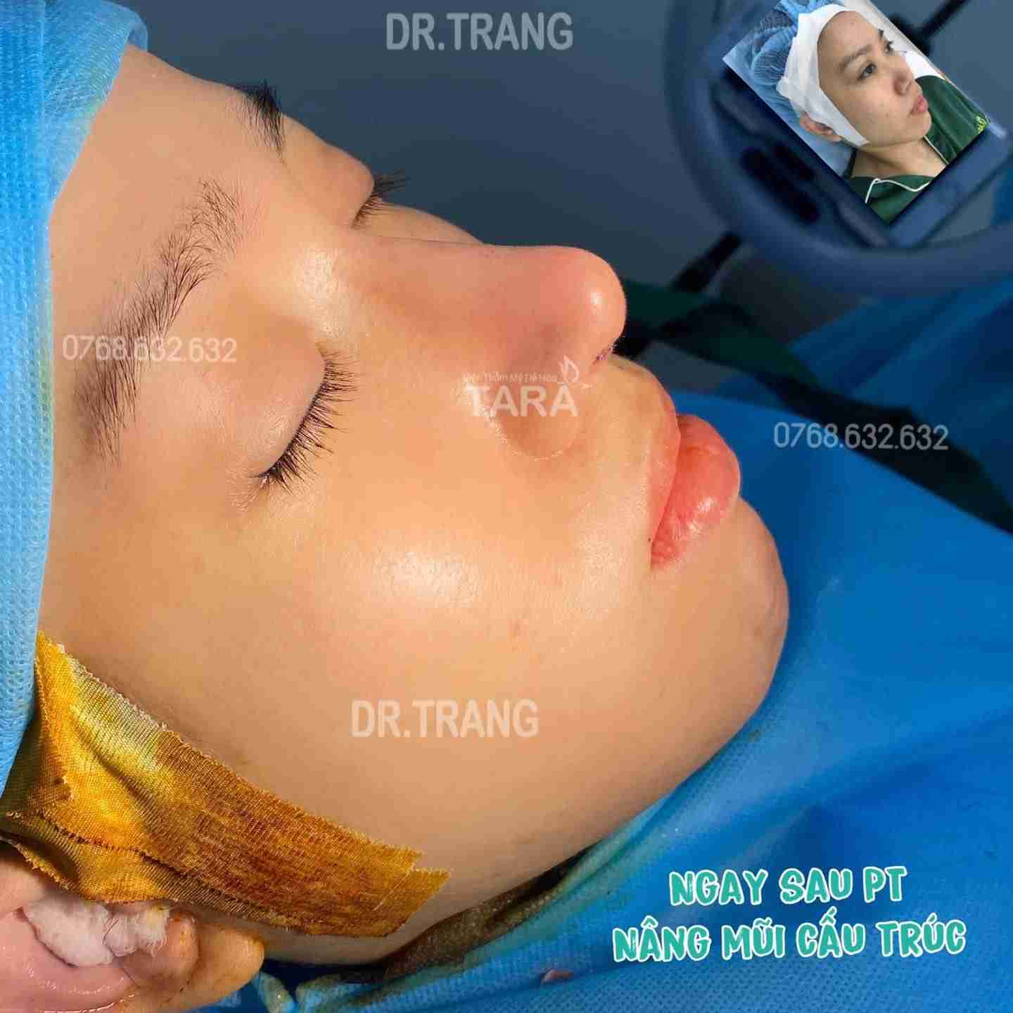Lưu ý quan trọng khi nâng mũi sau 10 ngày
