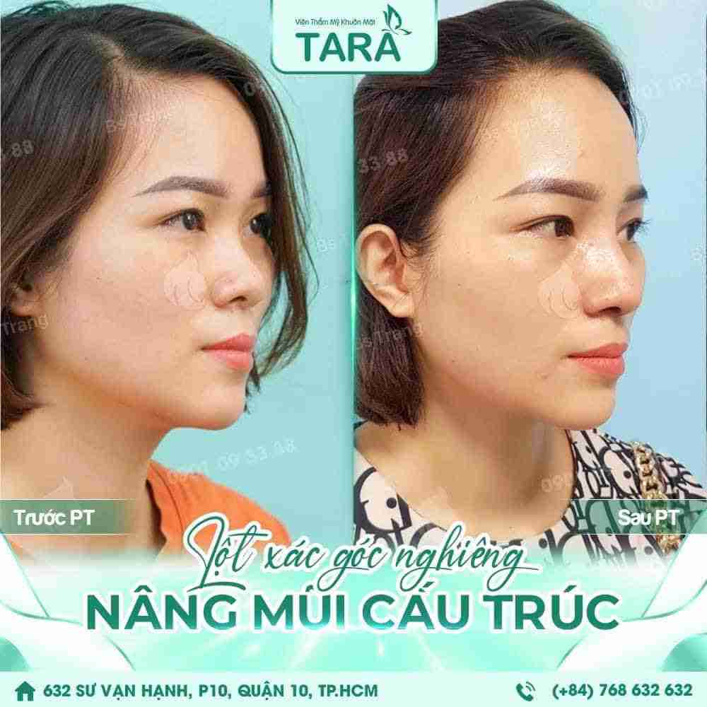  lưu ý quan trọng trước khi nâng mũi