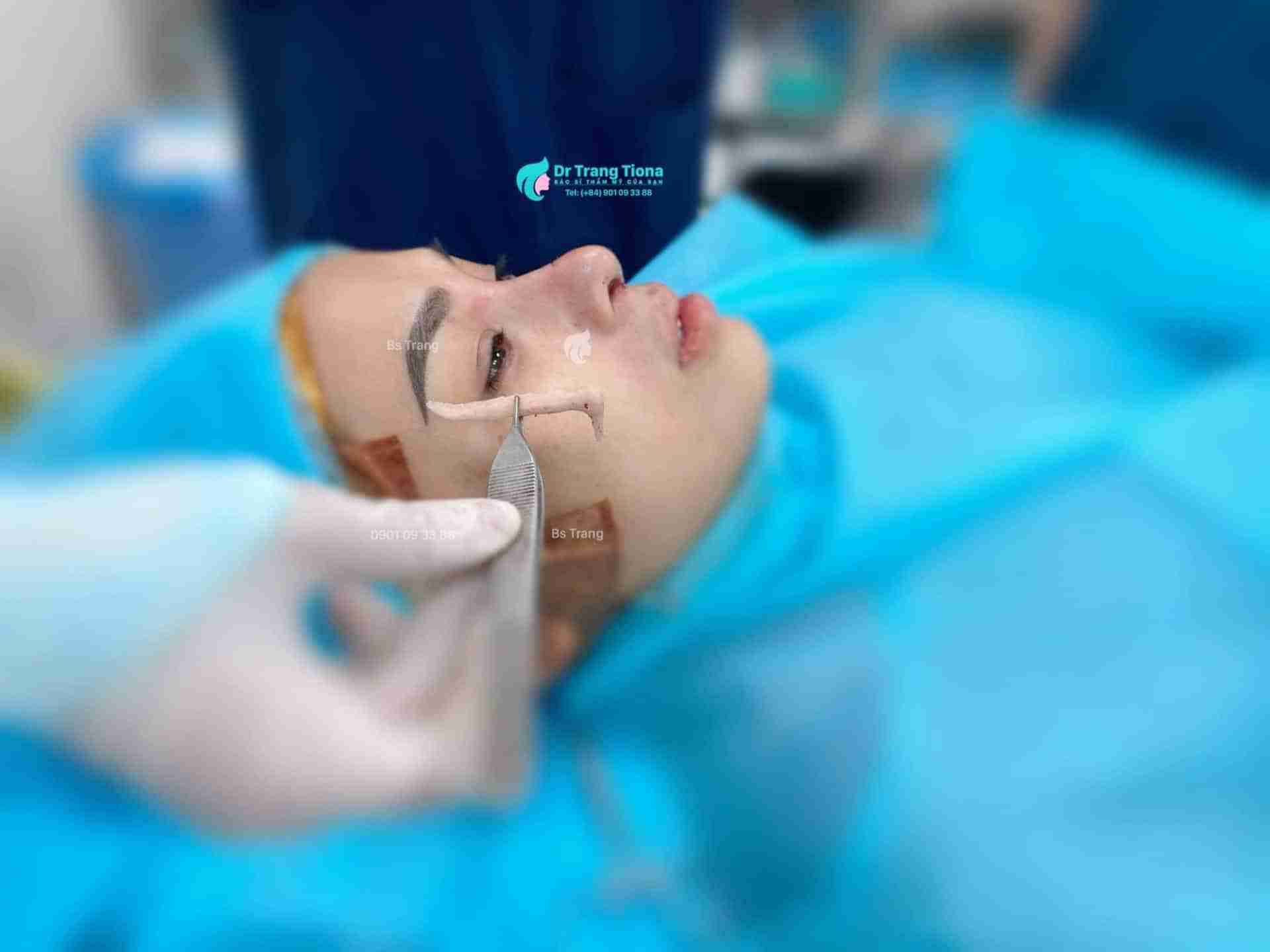  lưu ý quan trọng trước khi nâng mũi