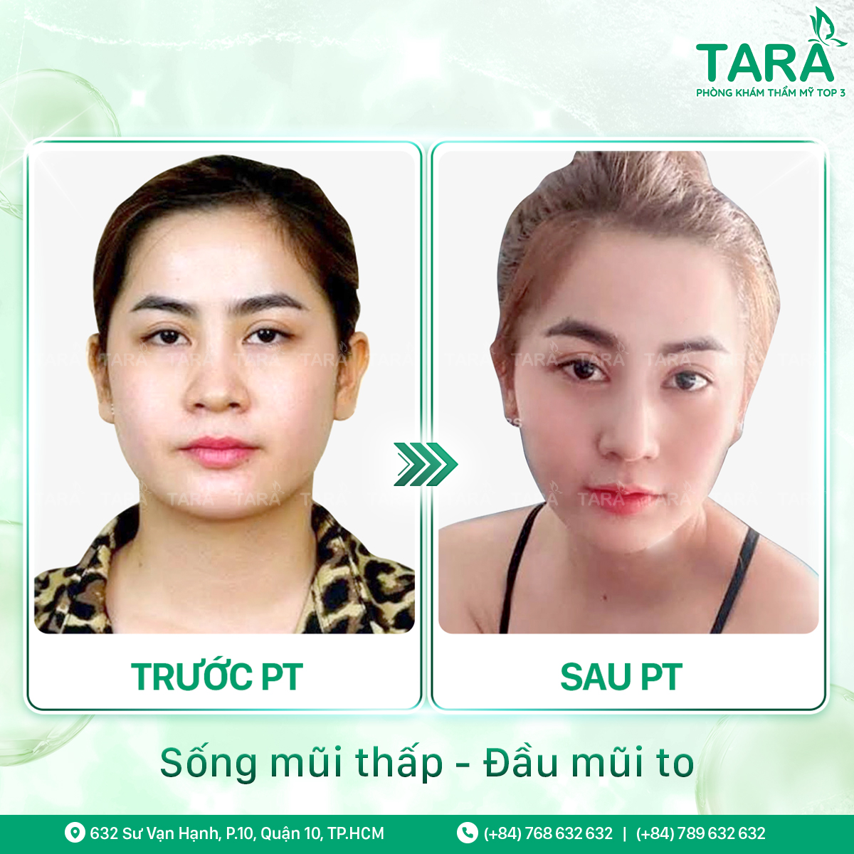 Bác sĩ nâng mũi giỏi tphcm Bác sĩ nâng mũi giỏi tphcm