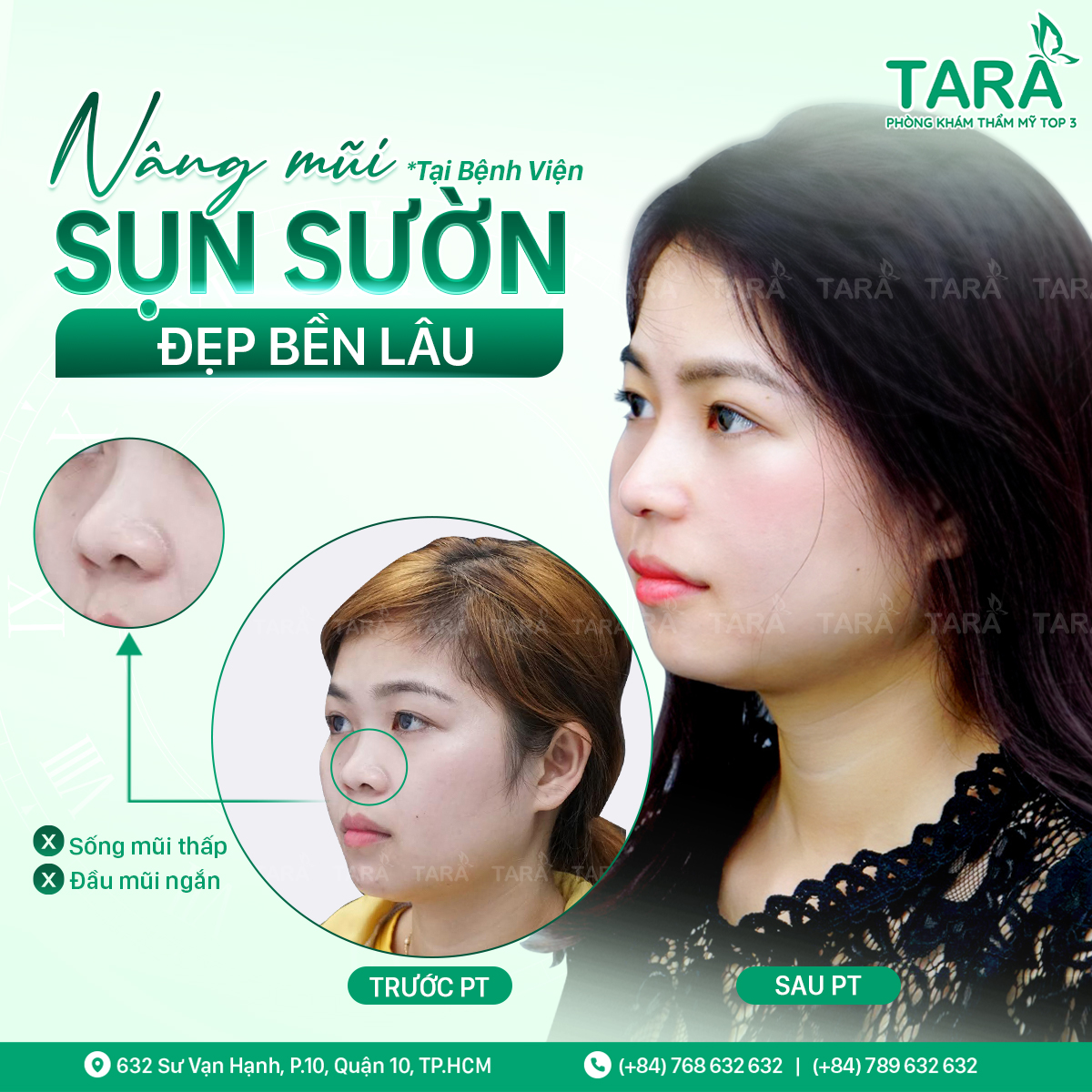Địa chỉ nâng mũi uy tín tại tphcm