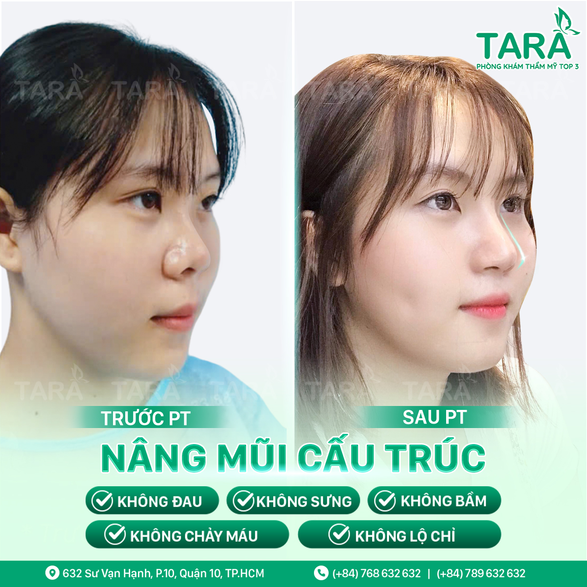 Địa chỉ nâng mũi uy tín tại tphcm