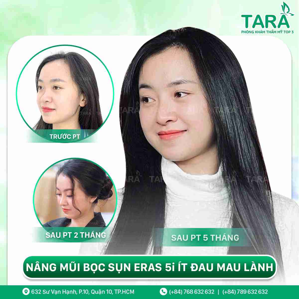 Nâng mũi sụn tự thân Nâng mũi sụn tự thân