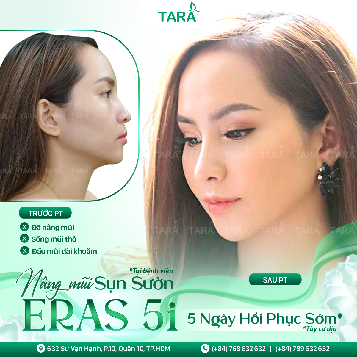 Nâng mũi sụn tự thân Nâng mũi sụn tự thân