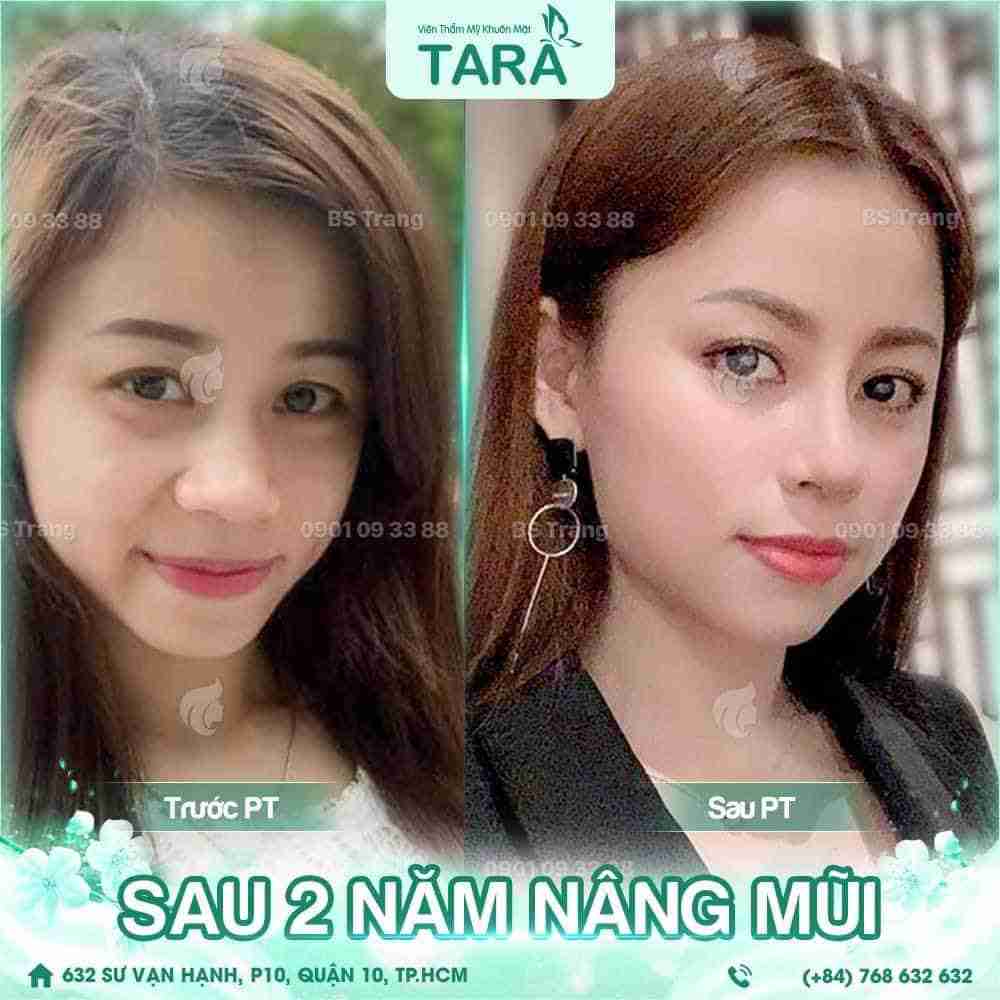 Nâng mũi có để lại di chứng phẫu thuật không