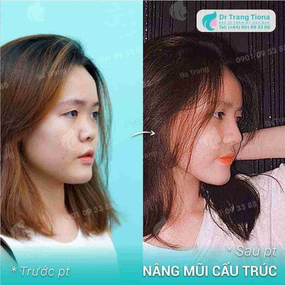 Phương pháp nâng mũi nào an toàn hiện nay?