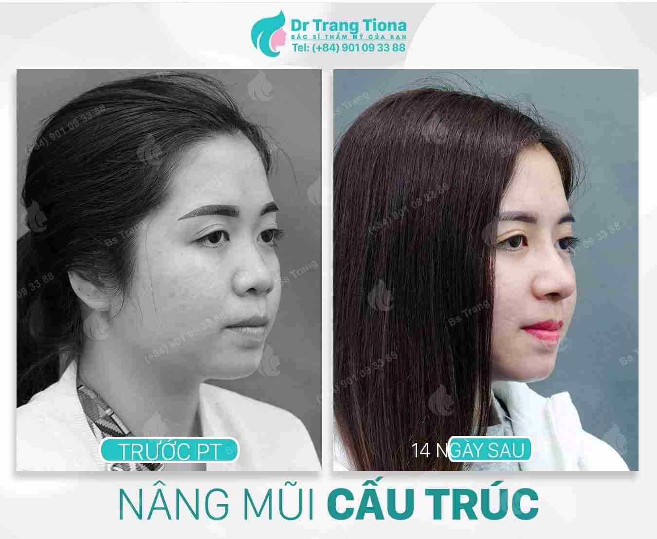 Dấu hiệu nhận biết dị ứng sụn sau nâng mũi