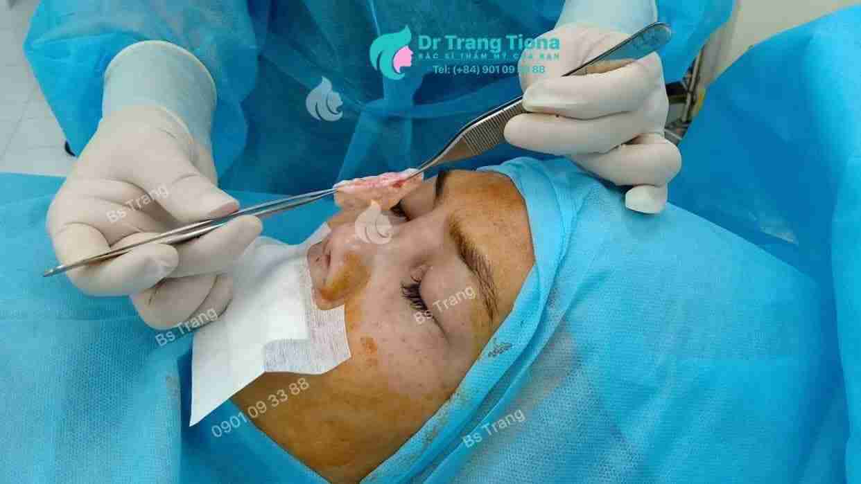 Dấu hiệu nhận biết dị ứng sụn sau nâng mũi