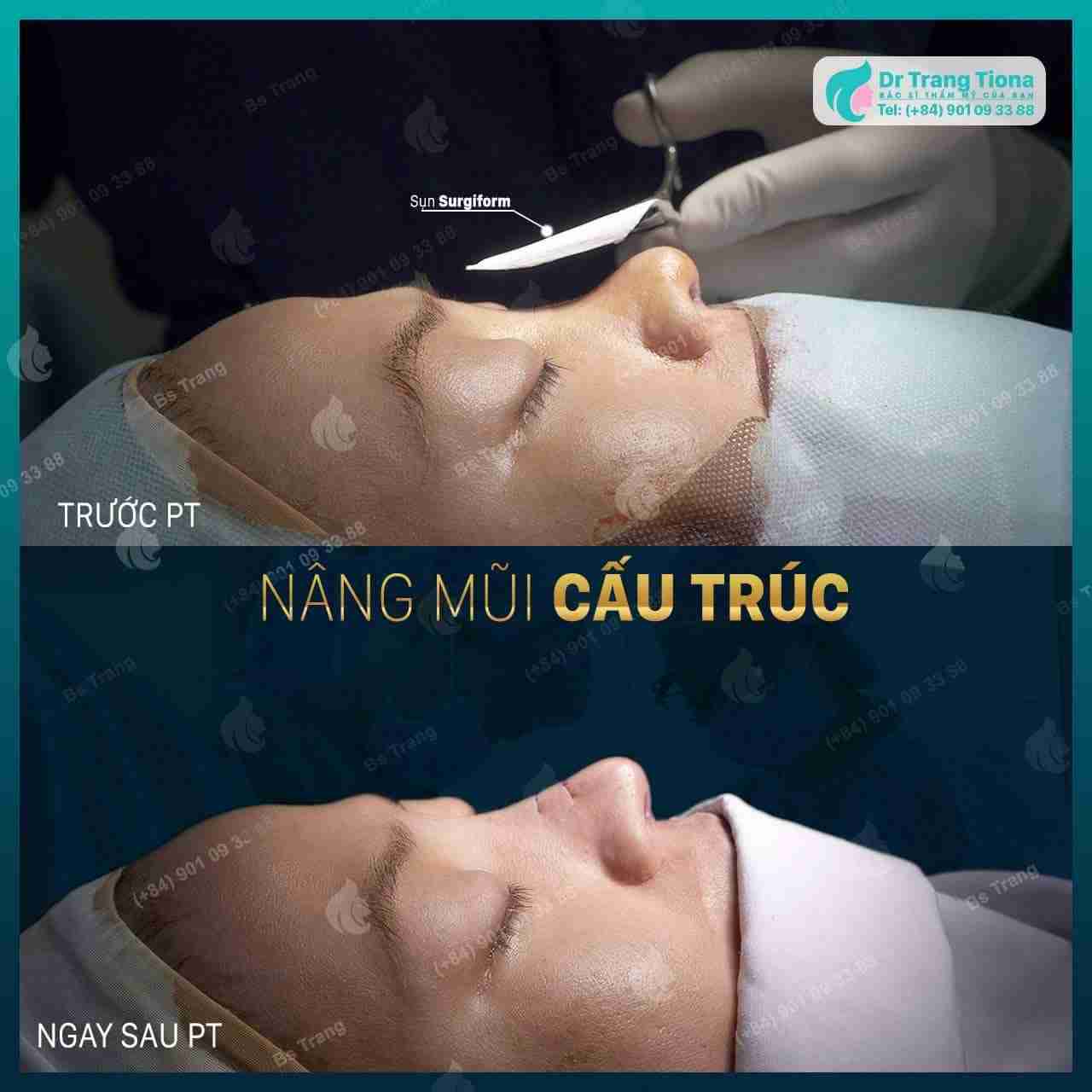 Dấu hiệu nhận biết dị ứng sụn sau nâng mũi