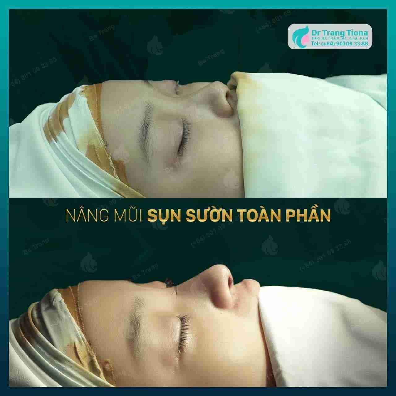 Nâng mũi sụn tự thân Nâng mũi sụn tự thân