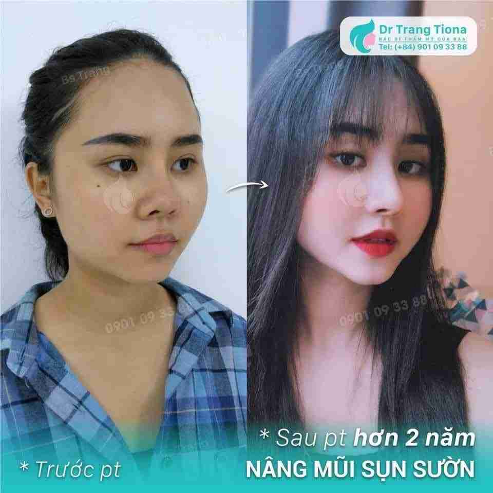 Bác sĩ giải đáp: Nâng mũi sụn tự thân có teo không?