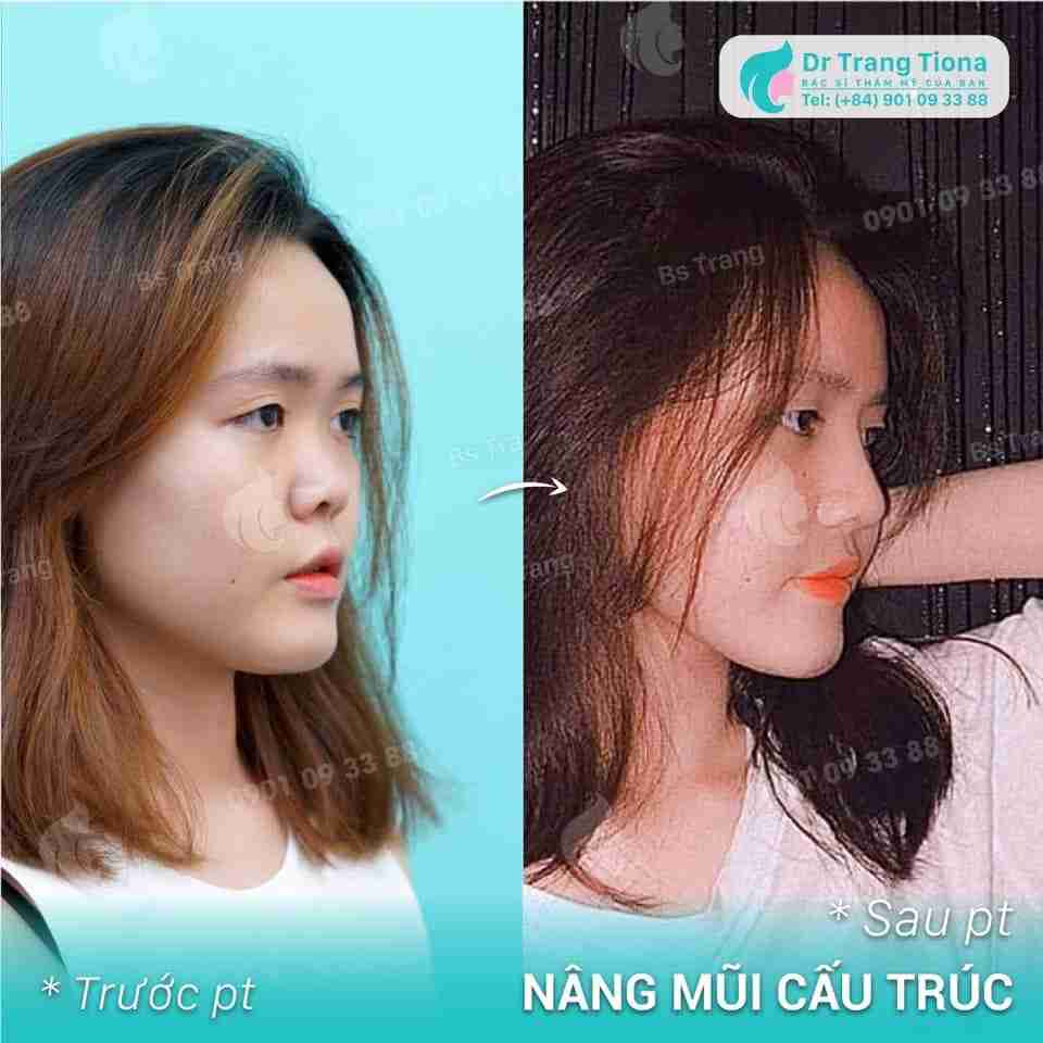 Nâng mũi cấu trúc bao lâu thì hết đau sưng đỏ?