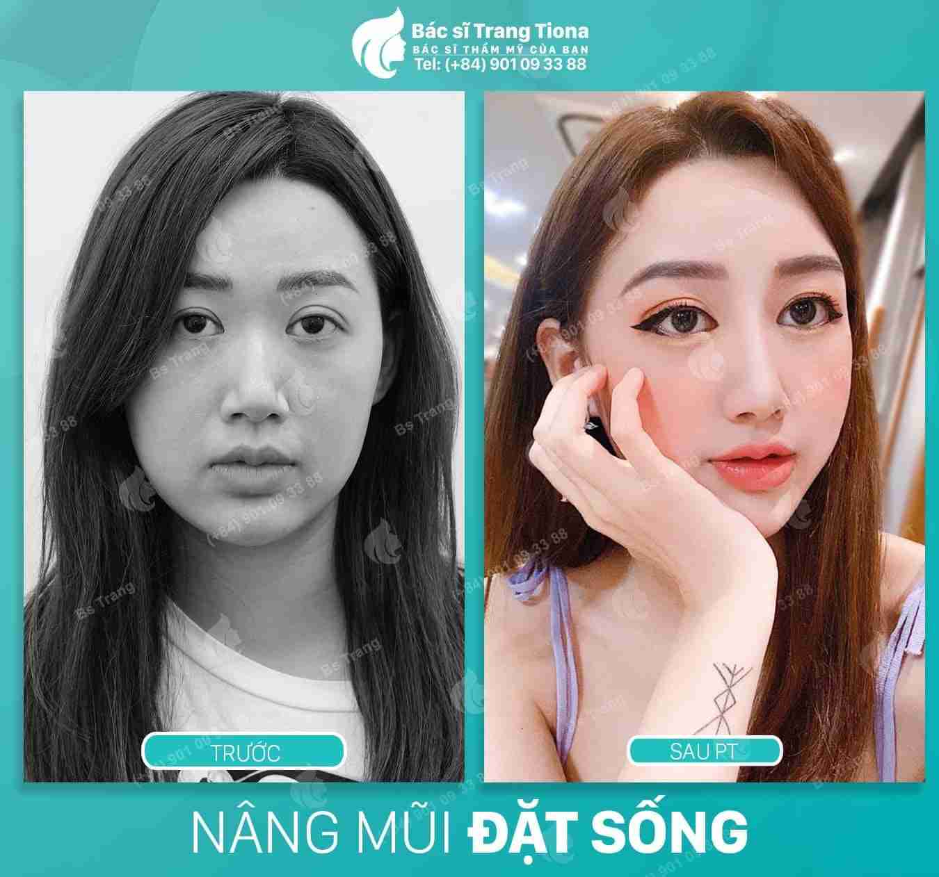Sau bao lâu thì được sờ nắn bóp mũi sau nâng?