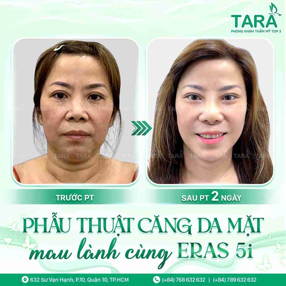 phẫu thuật căng da mặt