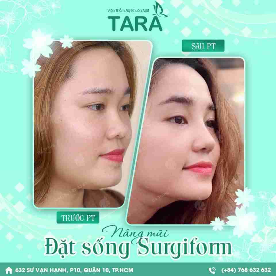 8 trường hợp không nên nâng mũi
