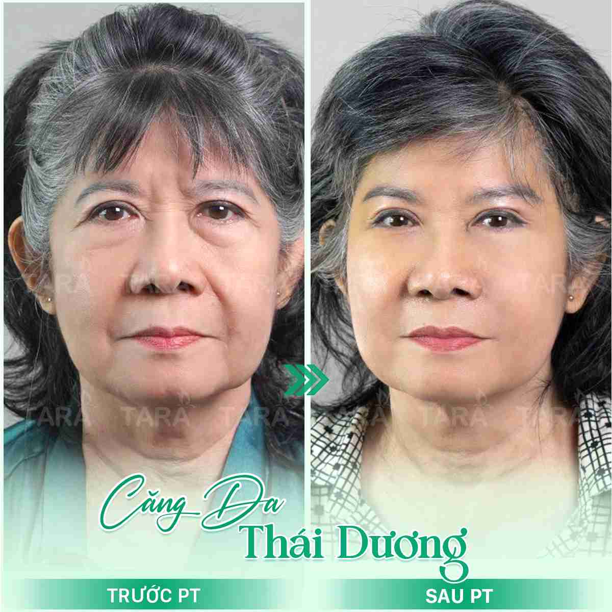 phẫu thuật căng da mặt