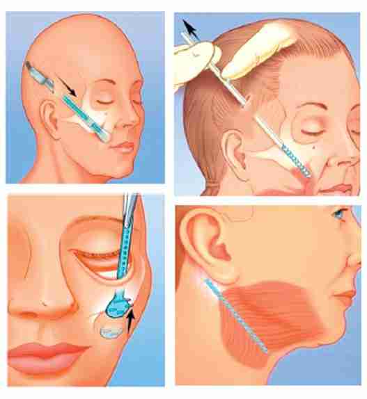 Bác sĩ giải đáp: Căng da mặt có phải gây mê không?