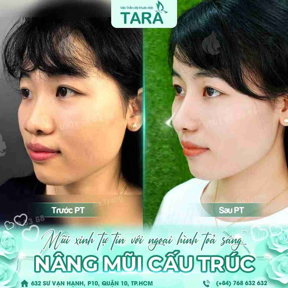Nâng mũi sau một tháng đã lành và đẹp chưa