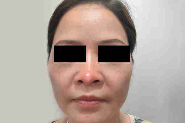 4 biến chứng thường gặp khi nâng mũi bằng sụn nhân tạo