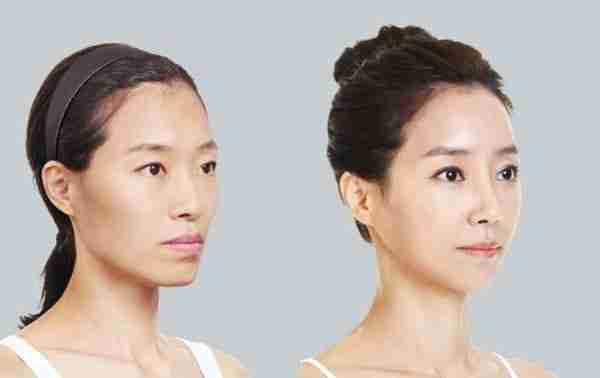 Bác sĩ giải đáp: Cấy mỡ mặt Babyface bao lâu thì đẹp?