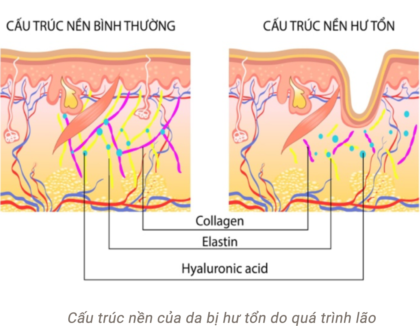 Nên căng da mặt hay cấy mỡ mặt điều trị lão hóa