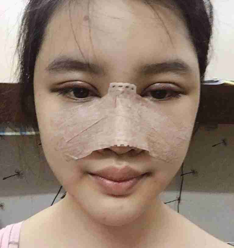 4 dấu hiệu nhận biết mũi bị biến chứng sau nâng mũi 