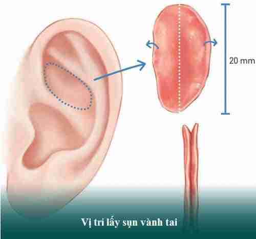 Nâng mũi bằng sụn tự thân nên chọn loại sụn nào thì tốt nhất?