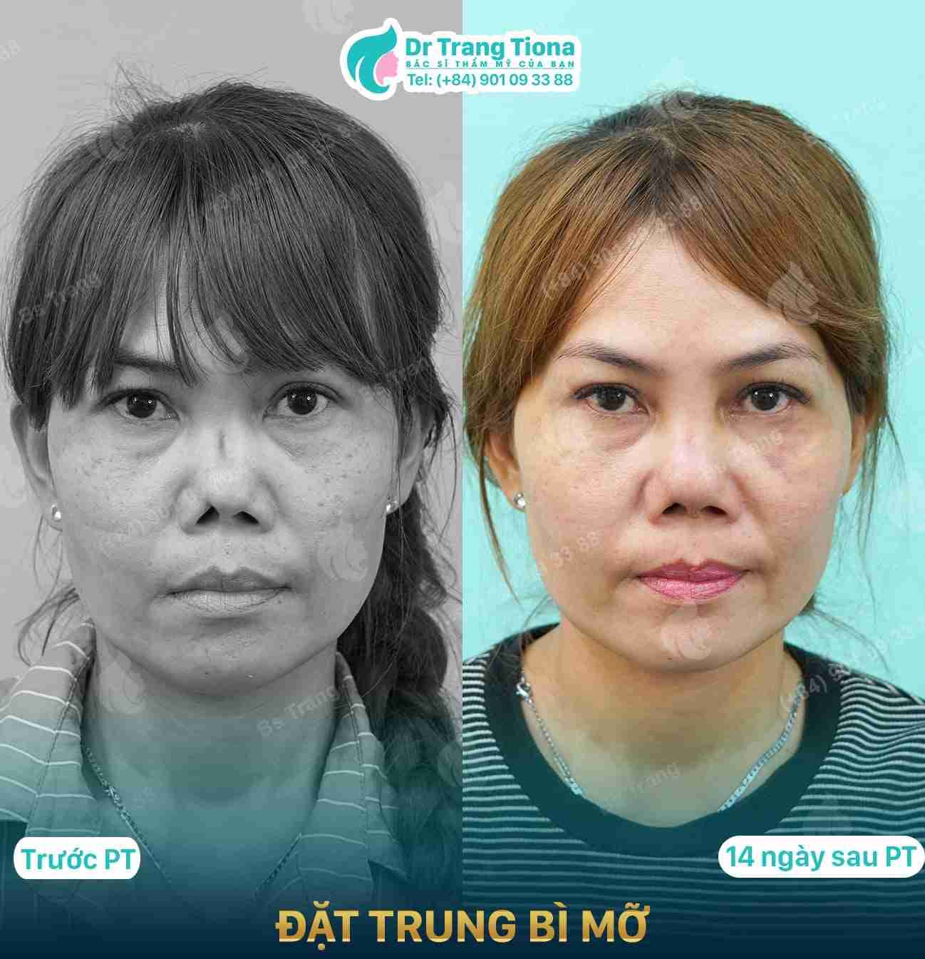 Nâng mũi bằng sụn tự thân nên chọn loại sụn nào thì tốt nhất?