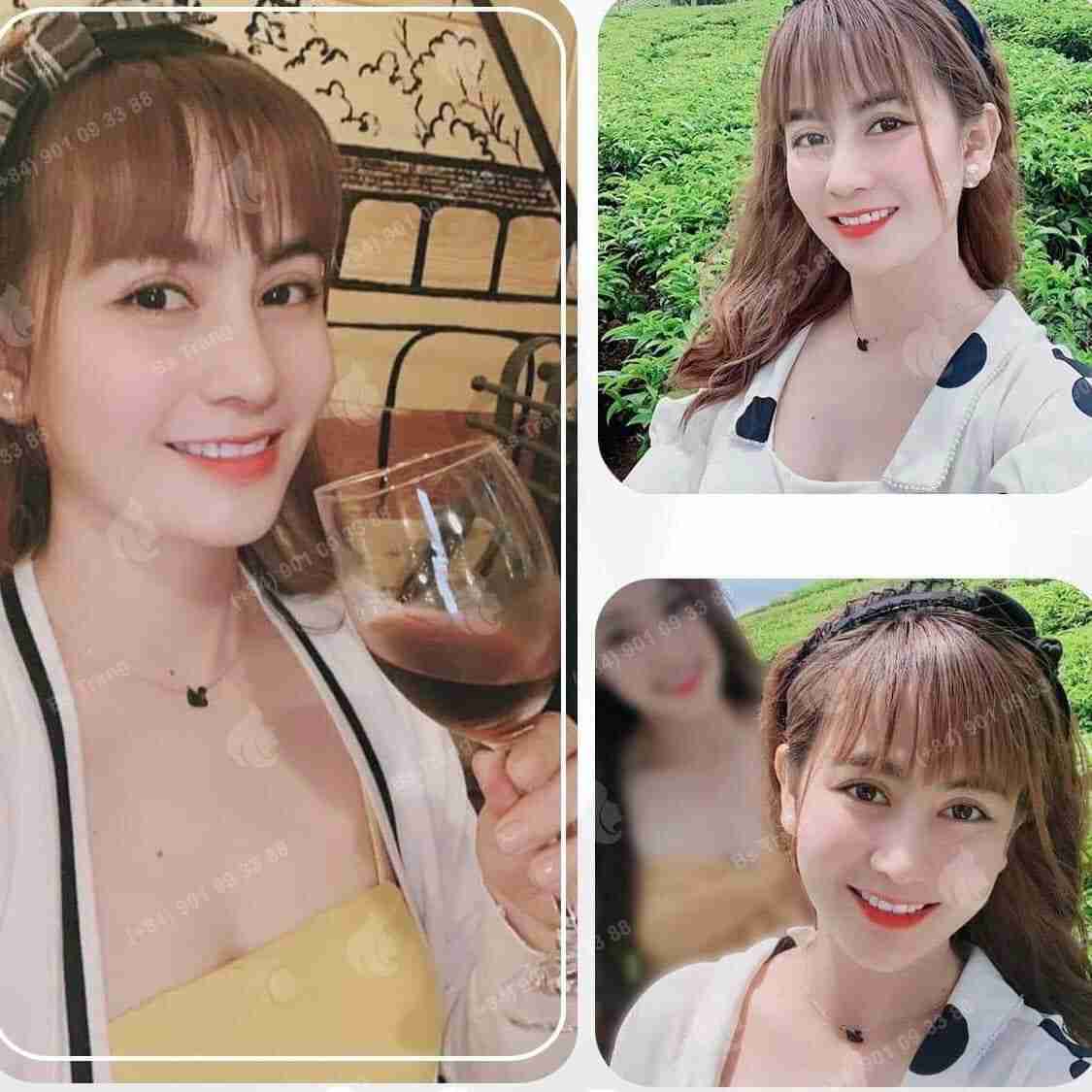 Bác sĩ giải đáp: Nâng mũi xong cười bị đơ có sao không?