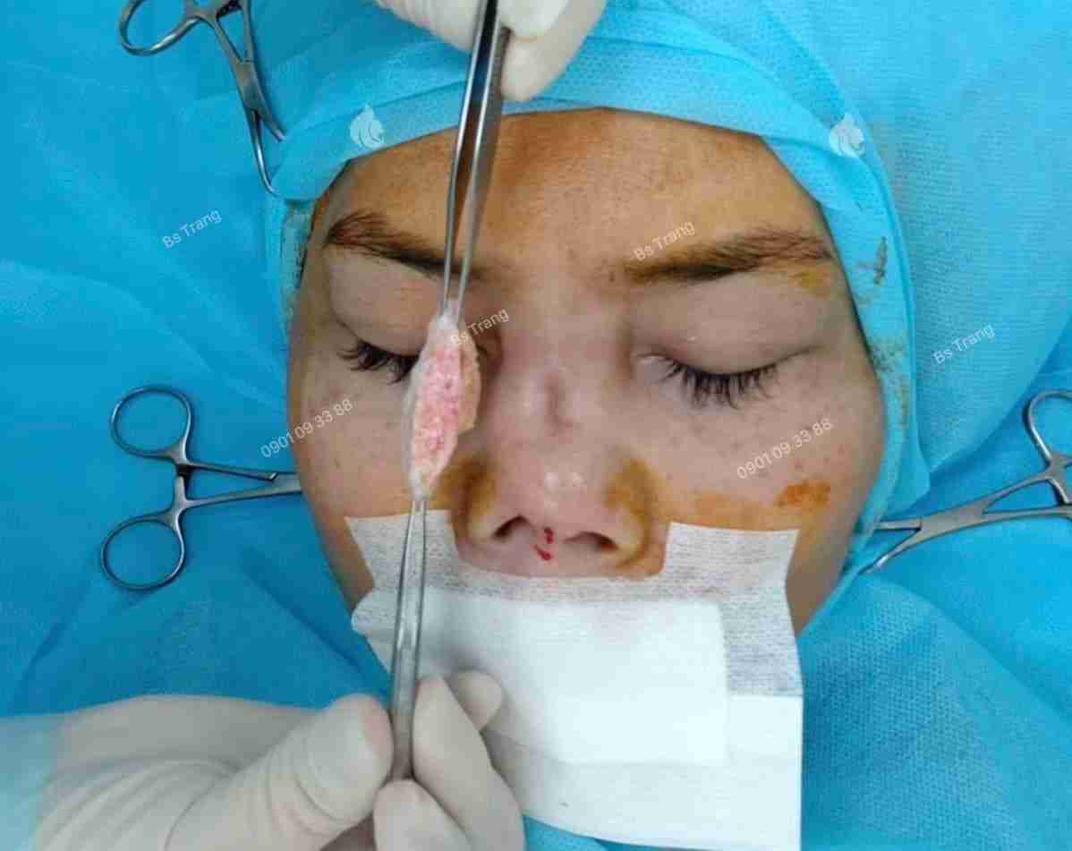 Có được sử dụng trung bì mỡ của người khác để nâng mũi không?