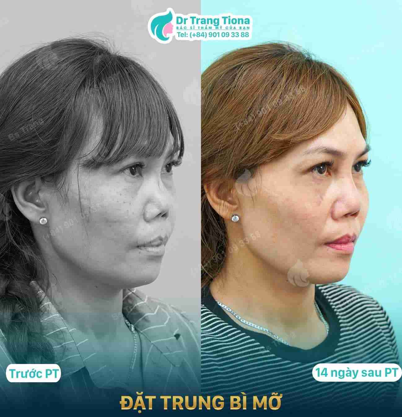 Tổng quan về nâng mũi trung bì mỡ 