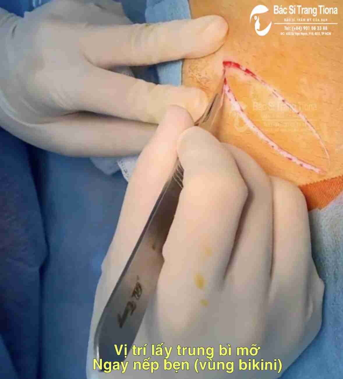 Tổng quan về nâng mũi trung bì mỡ 