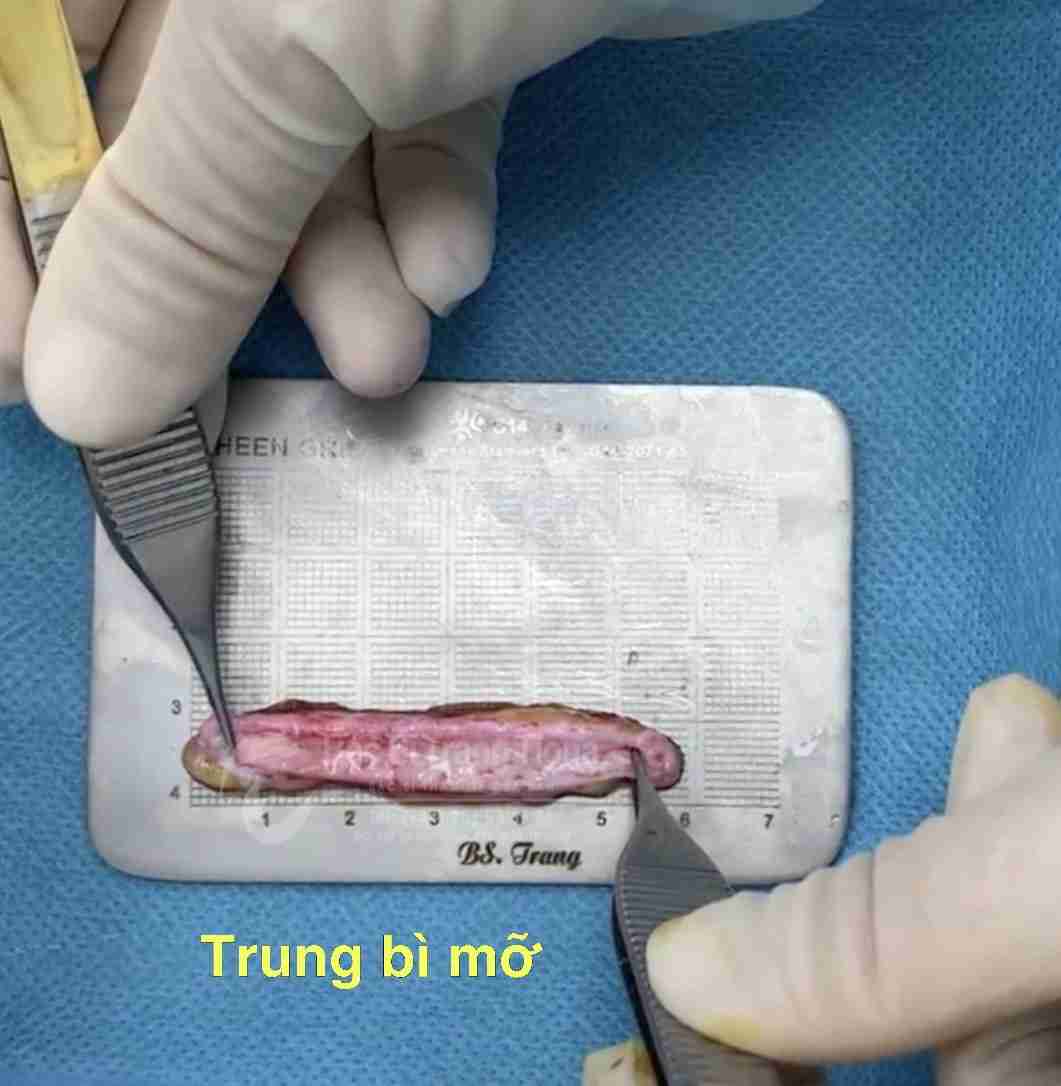 Tổng quan về nâng mũi trung bì mỡ 