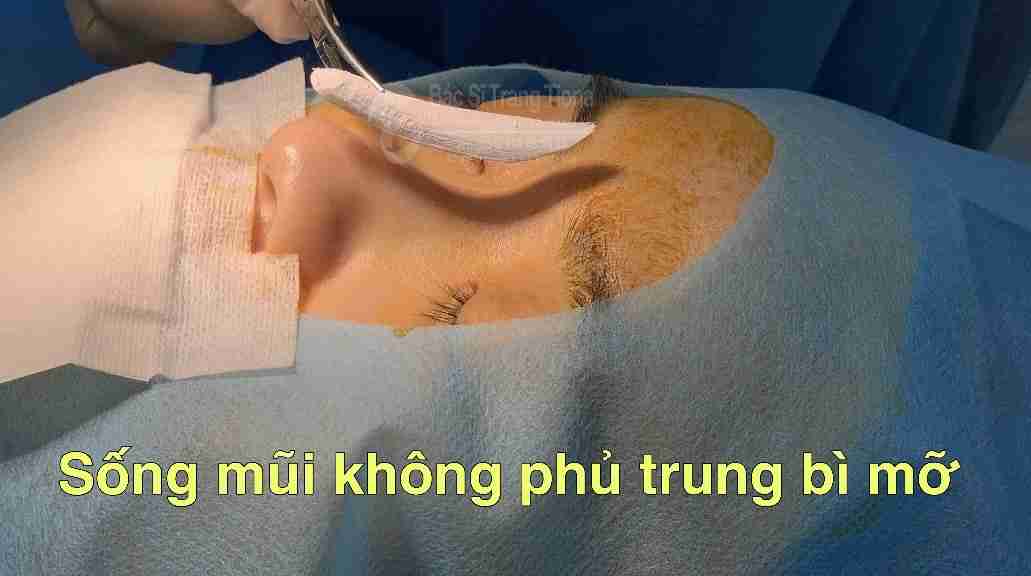 Tổng quan về nâng mũi trung bì mỡ 