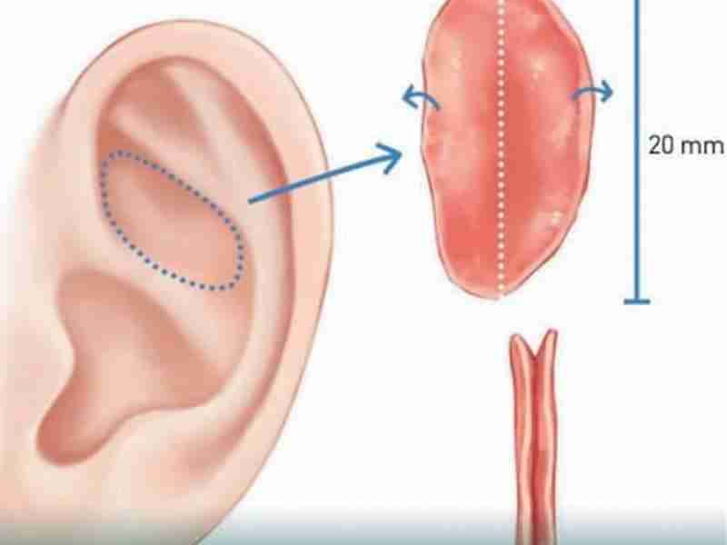 Tổng quan về nâng mũi trung bì mỡ 