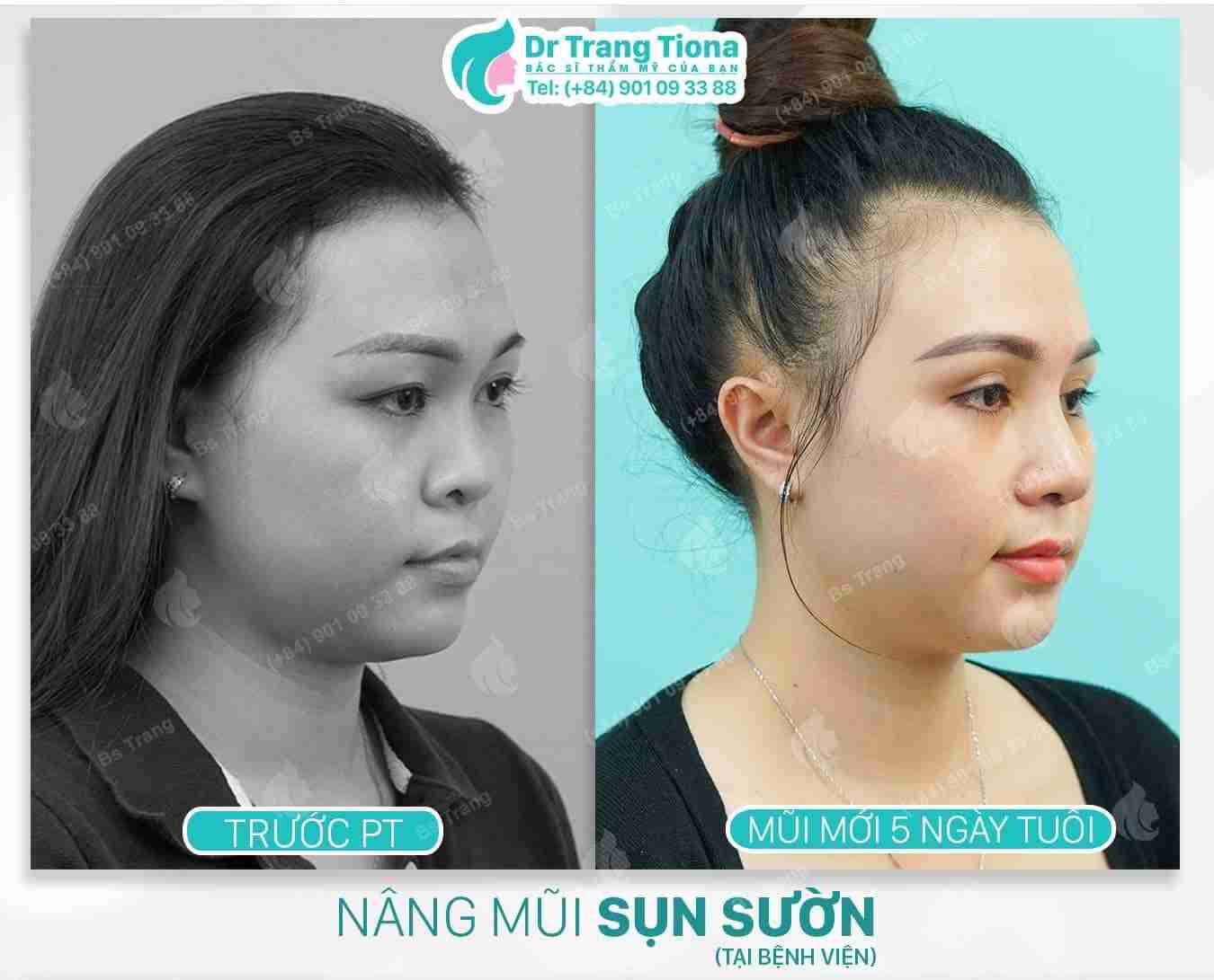 Tổng quan về nâng mũi trung bì mỡ 