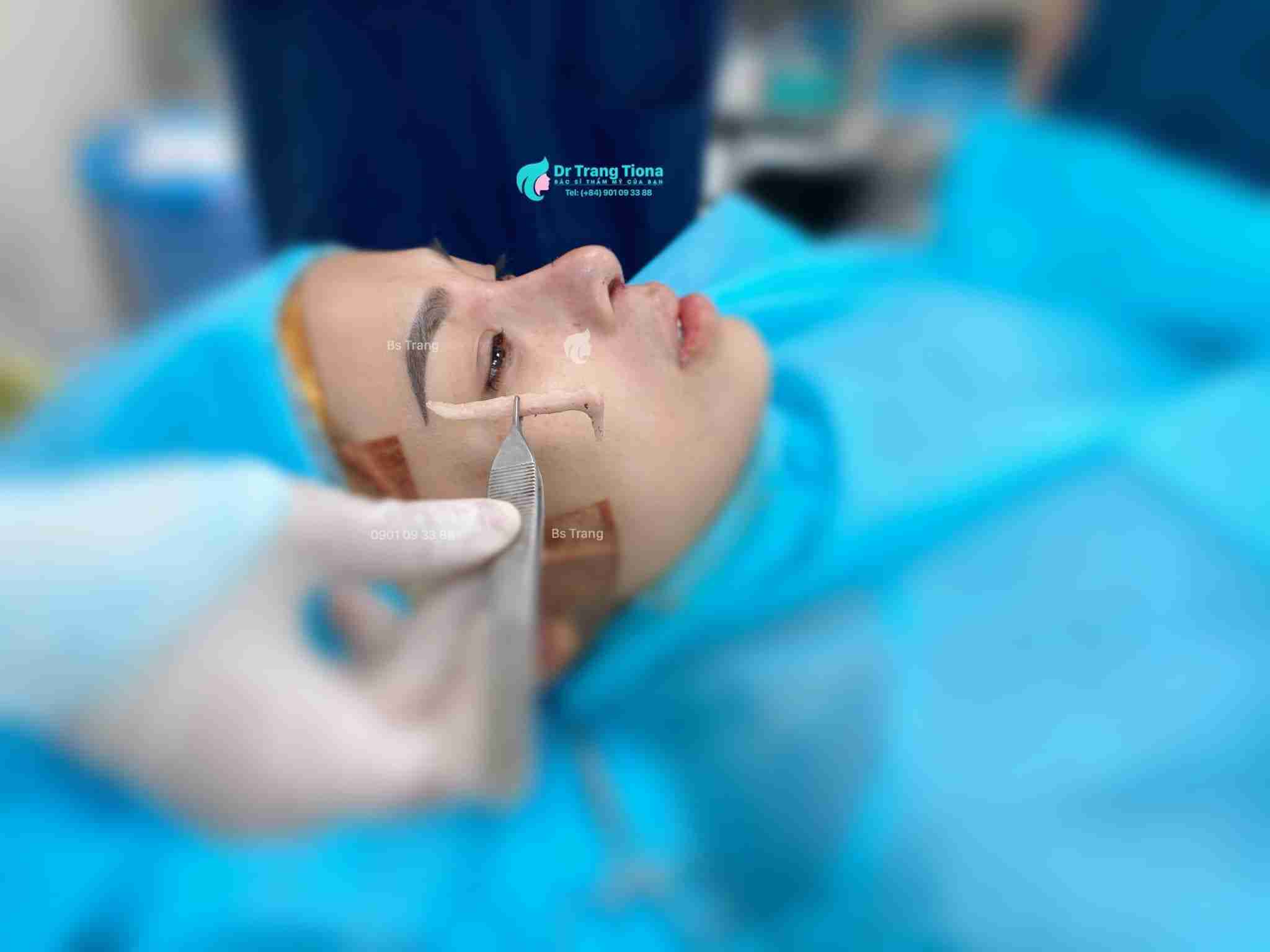 Vết khâu nâng mũi bị chảy dịch rỉ máu kéo dài có nguy hiểm không?