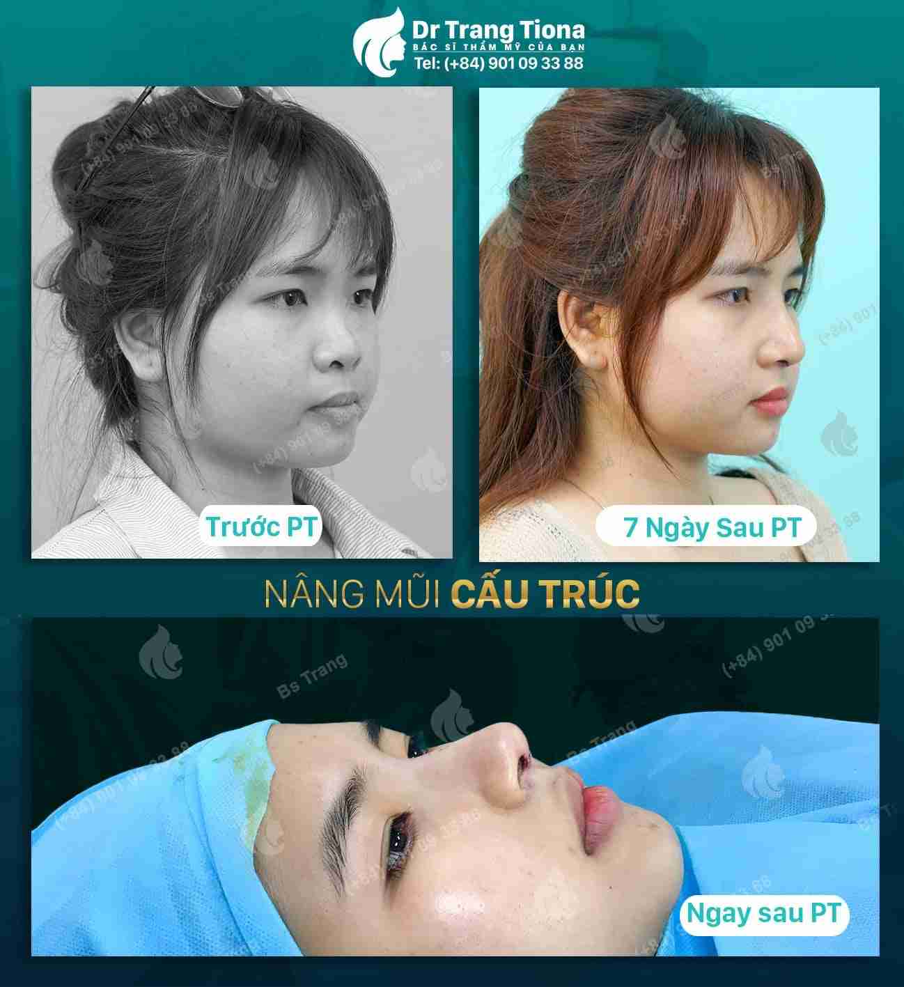 Sau khi nâng mũi nên làm gì để đạt được hiệu quả tốt nhất?