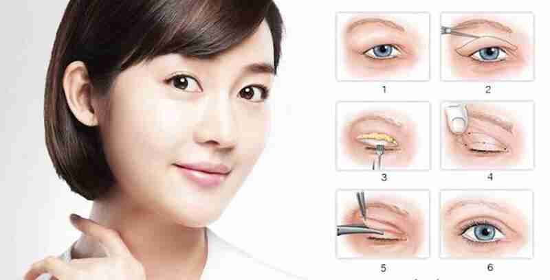 Giải đáp từ A-Z về phẫu thuật cắt mí mắt