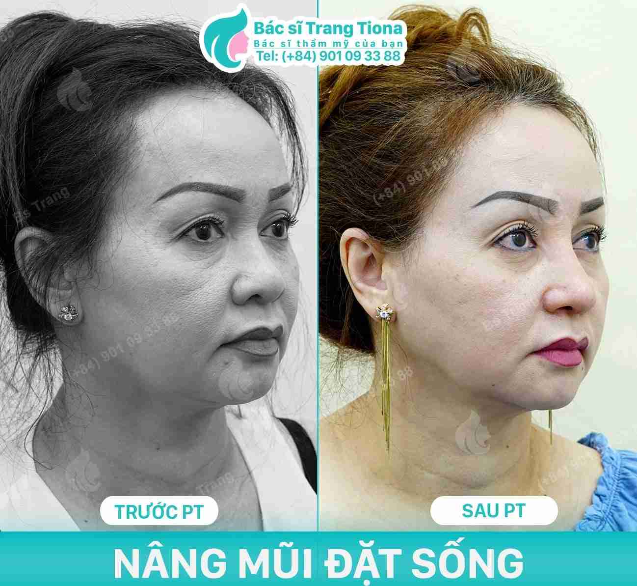 Bác sĩ giải đáp: Nâng mũi khi về già có sao không?